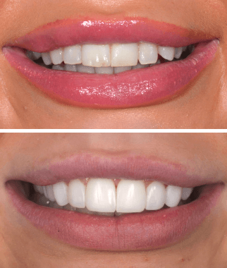 Before and after treatment at Space Dental