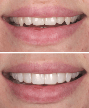 Before and after treatment at Space Dental