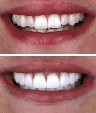 Before and after treatment at Space Dental