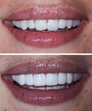 Before and after treatment at Space Dental